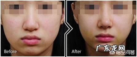 鼻子又大又塌,我该怎么办?