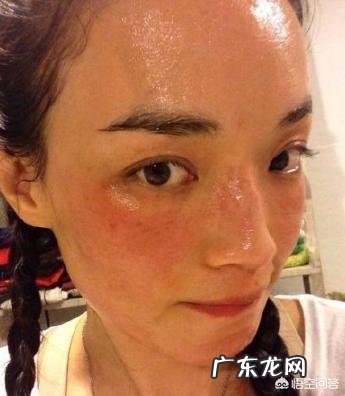 我脸上的红血丝很重,怎么祛除?