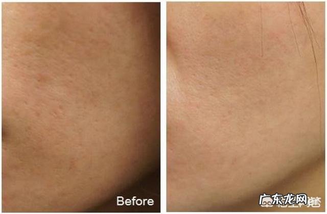 脸上之前长痘留下好多痘坑,该怎么办?