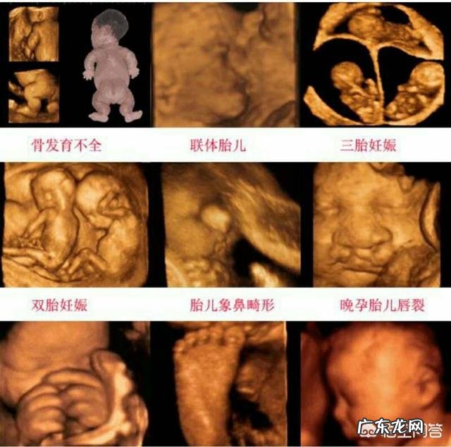 无创DNA什么情况下需要做?