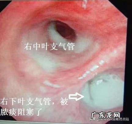 如何正确对待儿童咳嗽?