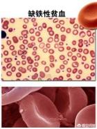 贫血怎么食补，吃什么呢？