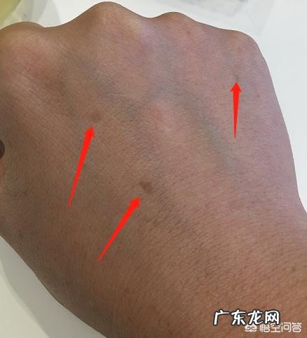 产生黄褐斑的原因有哪些?黄褐斑能自己消退吗?