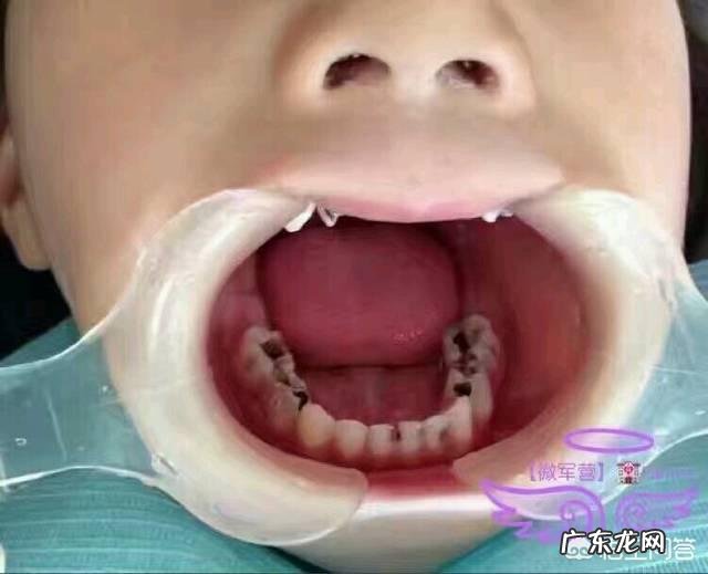 孩子有龋齿,未换牙,一般要怎么处理?