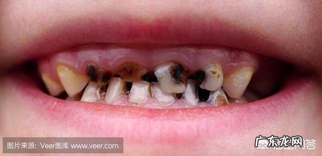 孩子有龋齿,未换牙,一般要怎么处理?