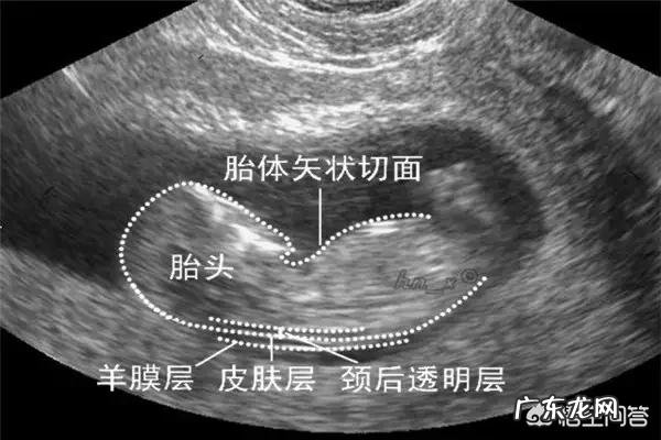 胎儿智力低下可以检查出来吗?