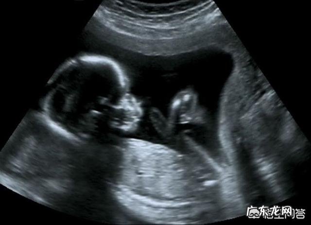 胎儿智力低下可以检查出来吗？