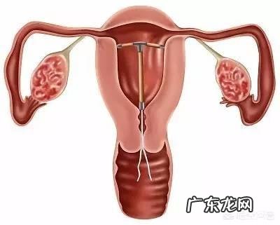 上环有哪些坏处?