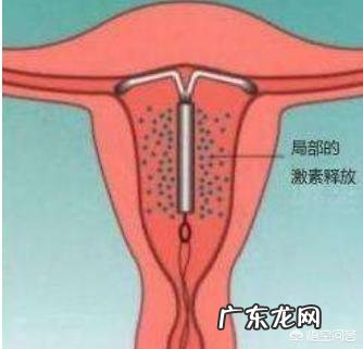 上环有哪些坏处?