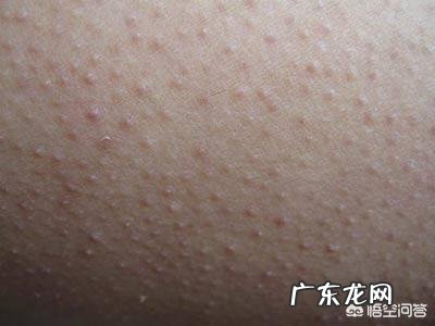 身上“鸡皮肤”明显,而且还很难看,应该如何去除呢?