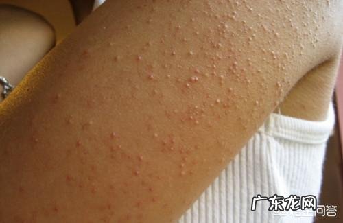 身上“鸡皮肤”明显,而且还很难看,应该如何去除呢?