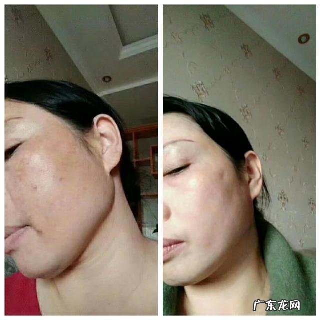 白醋泡白术,能祛斑吗?