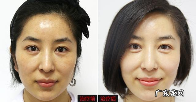 白醋泡白术,能祛斑吗?