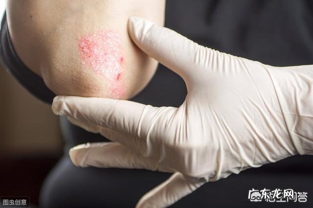 手上起了很多的小水泡怎么办?