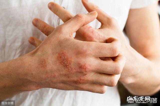 手上起了很多的小水泡怎么办?