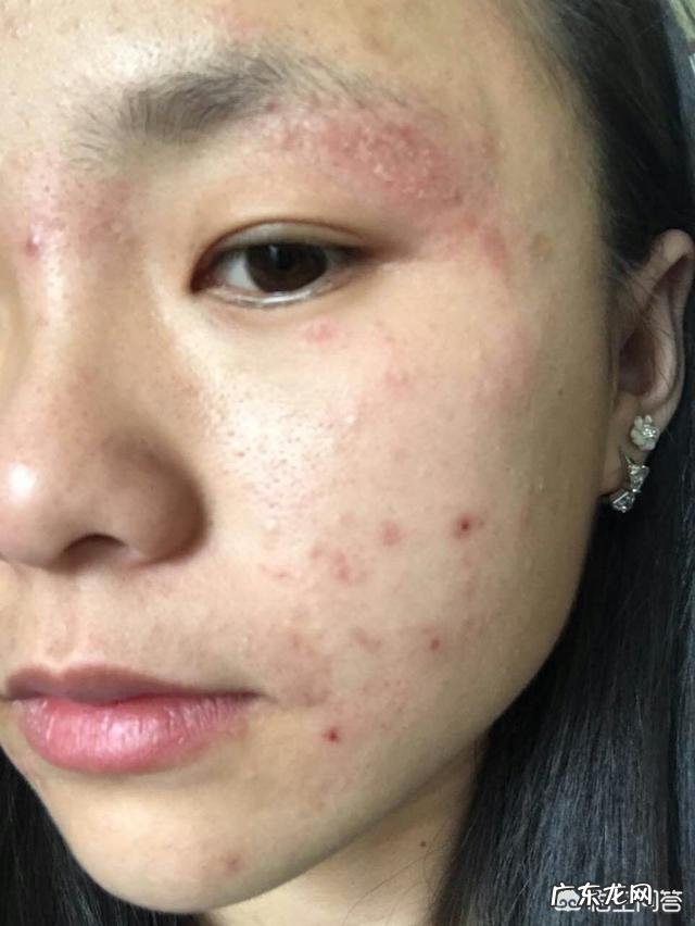 如何正确祛痘？