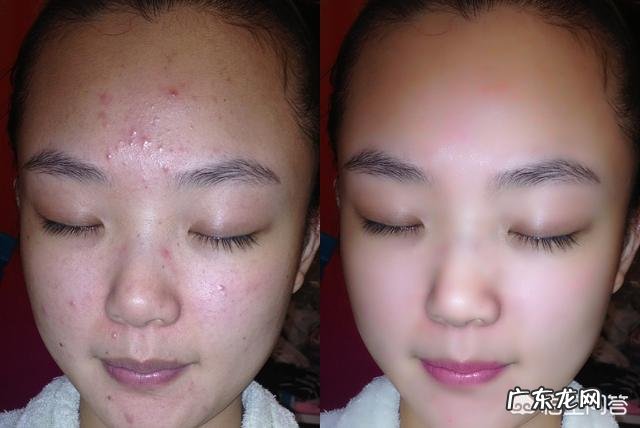 如何正确祛痘？
