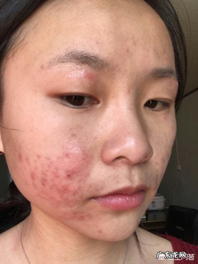 如何正确祛痘？