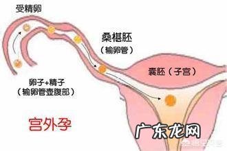宫外孕有那些症状?