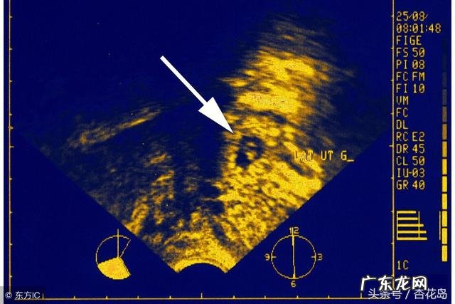 宫外孕有那些症状?