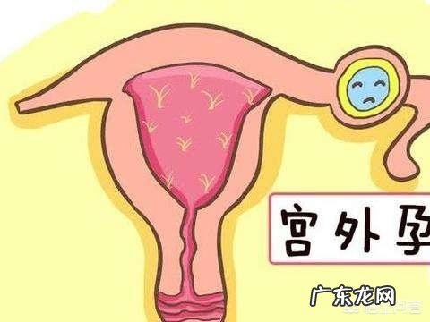 宫外孕有那些症状?