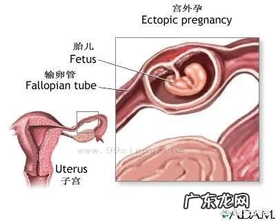 宫外孕有那些症状?