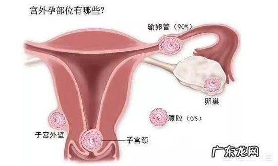 宫外孕有那些症状?