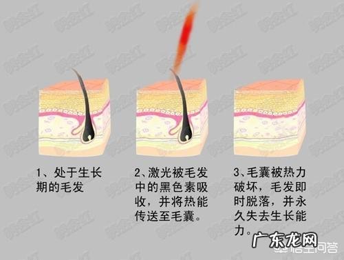 永久脱毛是真的吗？