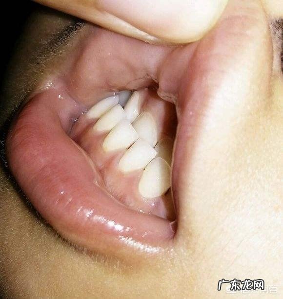 宝宝“地包天”,需要矫正吗?