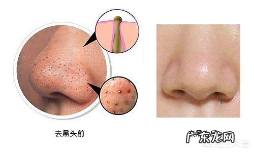 怎样去黑头粉刺?