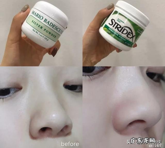 怎样去黑头粉刺?