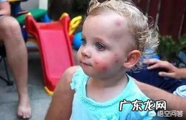 宝宝被蚊子咬了,哪些方法可以缓解呢?