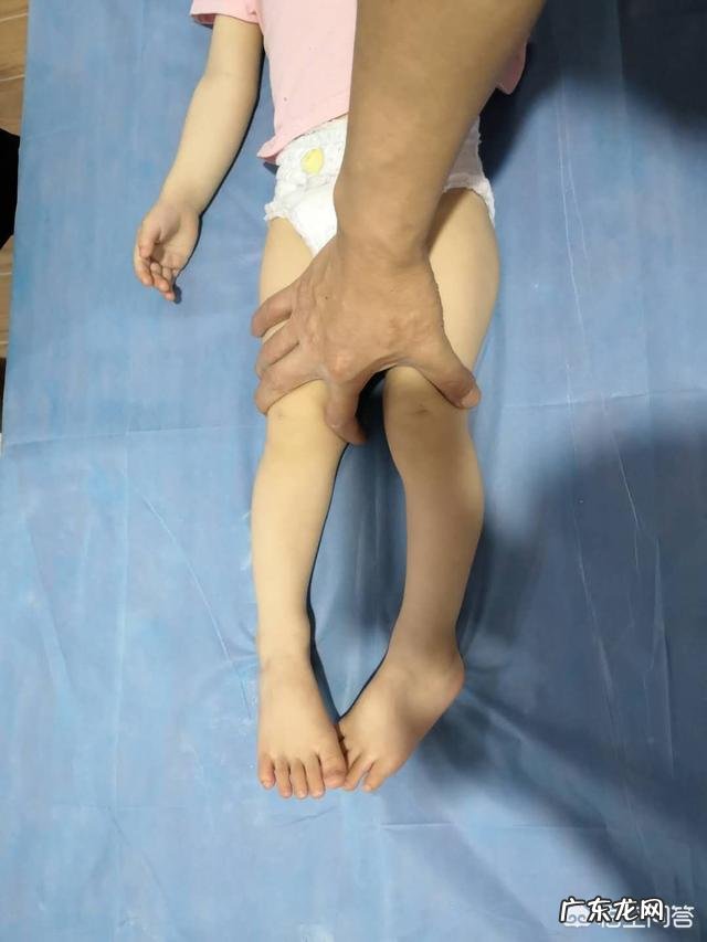 如何矫正罗圈腿?