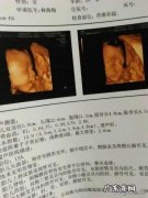 唐氏儿在四维下的特征是什么，自己能不能感觉到胎儿的不正常？