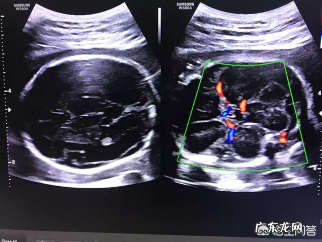 四维彩超几个月才能做?