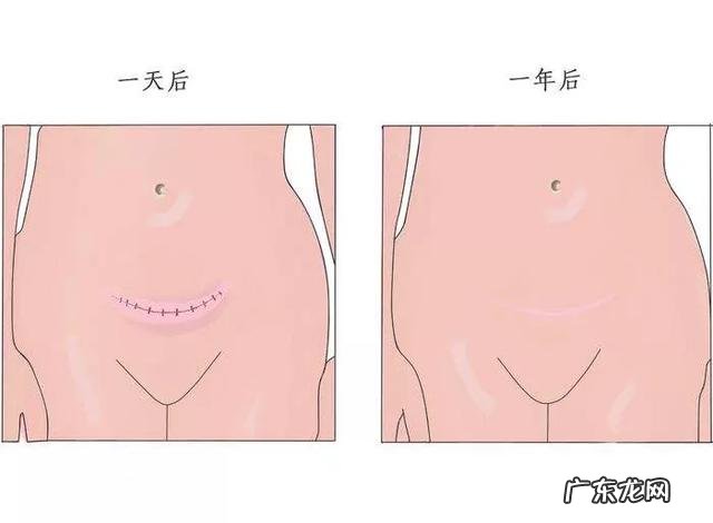 剖腹产多久后恶露会停？恶露排不完会有什么危害啊？