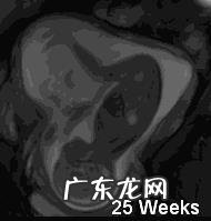 孕晚期胎动总在右边正常吗?对胎儿有没有影响?