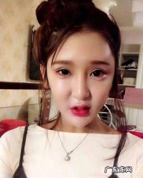 玻尿酸打多了会有副作用产生吗？