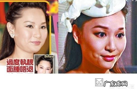 玻尿酸打多了会有副作用产生吗?