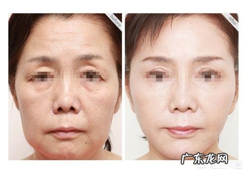 玻尿酸打多了会有副作用产生吗?