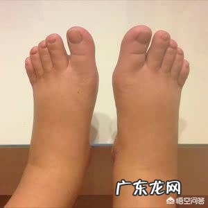 孕期出现水肿情况该怎么办？