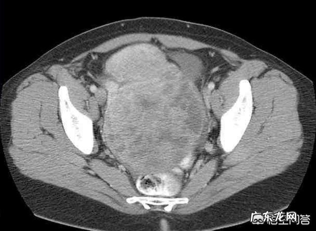 卵巢肿瘤的早期症状如何预防卵巢肿瘤?