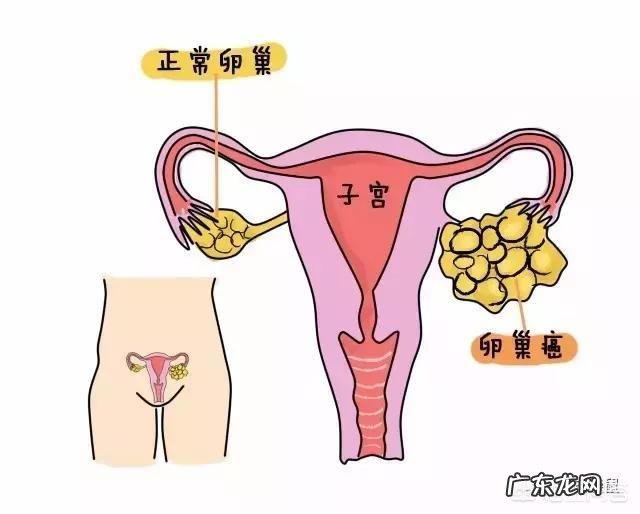 卵巢肿瘤的早期症状如何预防卵巢肿瘤?