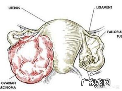 卵巢肿瘤的早期症状如何预防卵巢肿瘤?