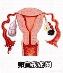 卵巢肿瘤的早期症状如何预防卵巢肿瘤?