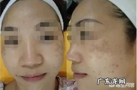 男士脸上有斑,怎么办?