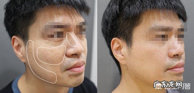 男士脸上有斑,怎么办?