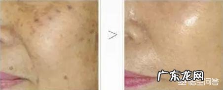 男士脸上有斑,怎么办?