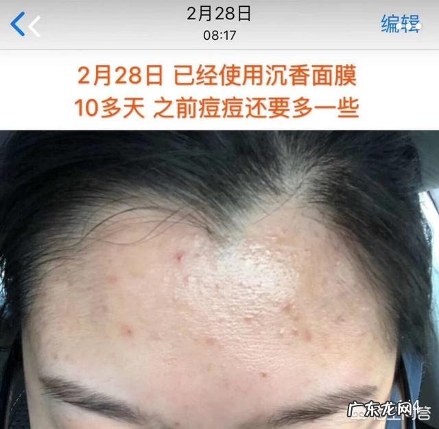 有没有祛痘痘、去闭口的面膜可以推荐?