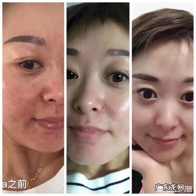 有没有祛痘痘、去闭口的面膜可以推荐?